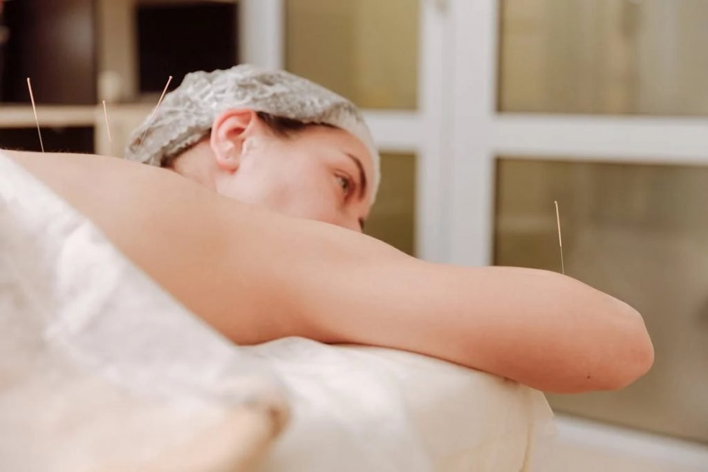 Image of Woman With Acupuncture Needles